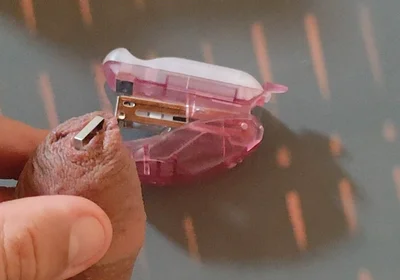 Intense Pleasure Stapling Phimosis