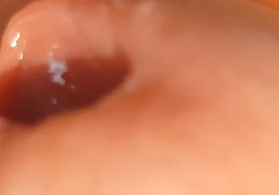 The Great Transformation of Phimosis Elastica.