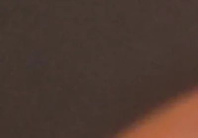 The Great Transformation of Phimosis Elastica.