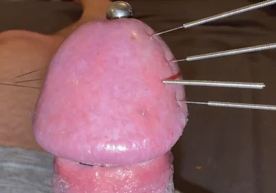 Needles Through the Thick, Hard Glans, Mega Orgasm