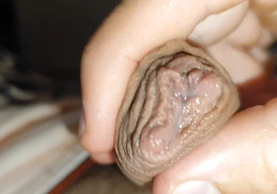 Silent Purge of Straight Scrotal Fluid.