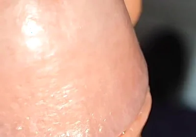 Extreme Application to the Syringe Inside the Glans!!