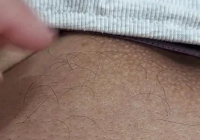 The Hair on My Penis - Led Hair Removal
