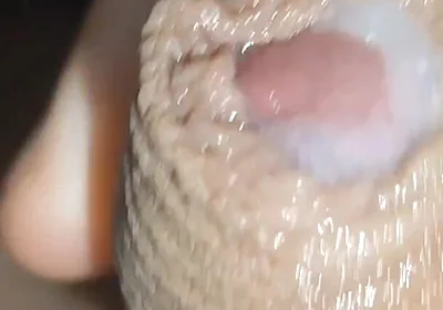 I Have the Largest Ejaculating Phimosis in the World!!