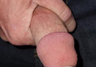 Gaping Urethra - Marker and Pinky Insertion