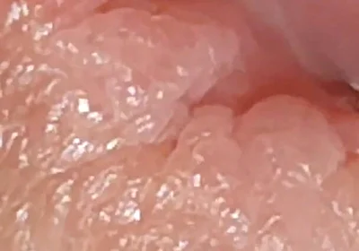 Enlargement of the Deep Urethral Hole!!