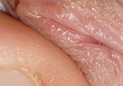 Enlargement of the Deep Urethral Hole!!