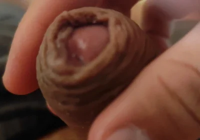 Great Phimosis Getting in the Way of the Boy's Orgasm