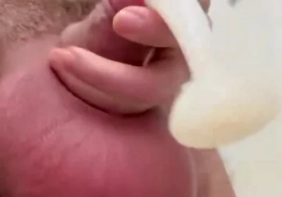 Inflated Ball Sack with Saline
