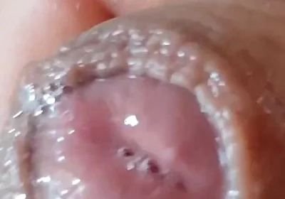 Deep Split in the Glans Produces Bubbling Liquid