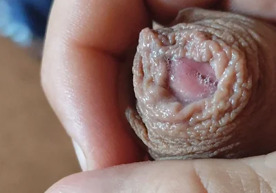 Deep Split in the Glans Produces Bubbling Liquid