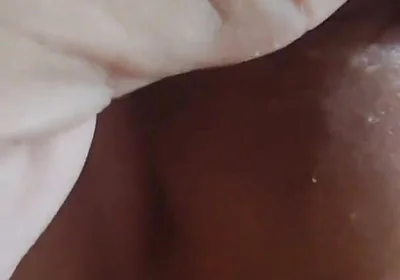 Application of Instant Phimosis Remover.