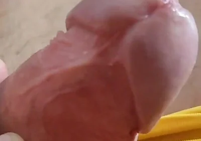 Scarred Frenulum Causes Glans Erection!