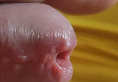 Scarred Frenulum Causes Glans Erection!