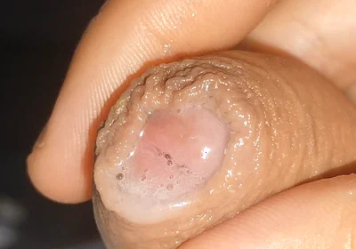 Curious Close-up of Pre-cum in Flaccid Phimosis.