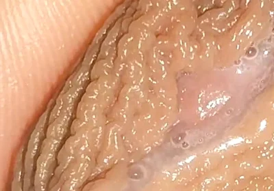 Curious Close-up of Pre-cum in Flaccid Phimosis.