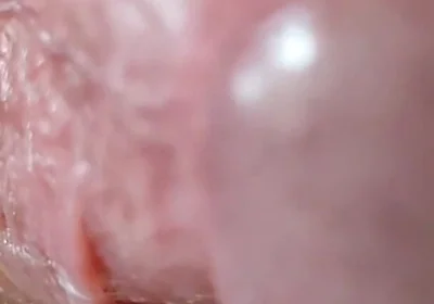 Opening the Scar of the Rough Frenulum!