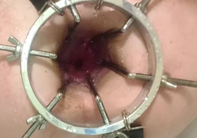 Enema, Anal Shower. Close-up View Through Anal Mirror. Anal with Water. Filling Anal with Water
