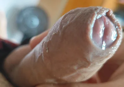 The Glans Appears Crowning Inside the Phimosis.