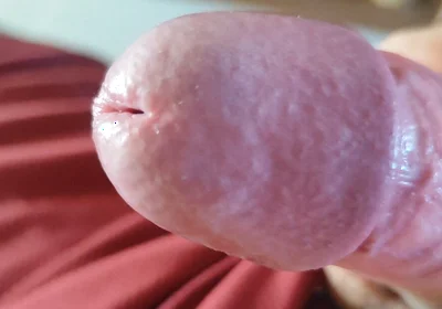 The Blossoming of Extensive Elastic Phimosis.