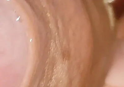 Large Cheese Accumulated in Close up of Glans