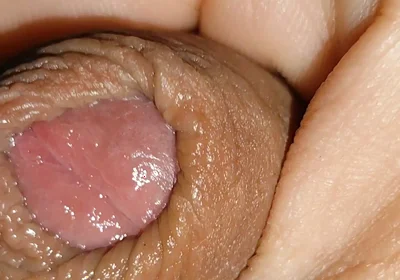 Boy with Large Anal Phimosis Excited!