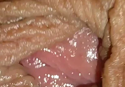 Boy with Large Anal Phimosis Excited!