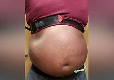 N2o Belly Inflation