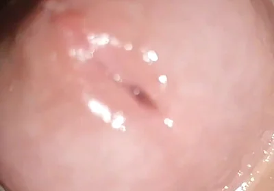Maximum Dilation of Phimosis Cumming.