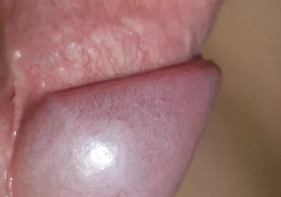 Amazing Upright Rough Venous Frenulum