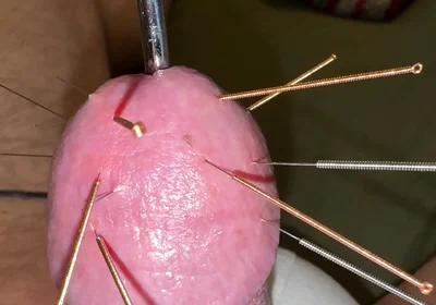 Acupuncture - Orgasm!