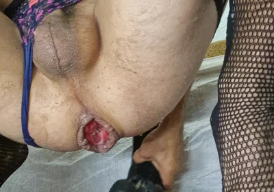 Analslutprolaps