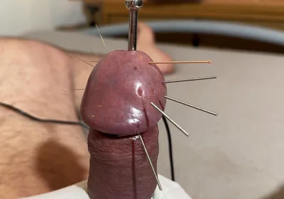 The Best Acupuncture Method!