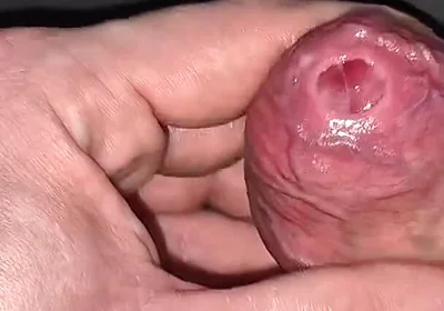 A Closer Look at My Naturally Tight Phimosis