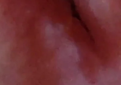 Dilation of the Glans Eye Has a Pleasant Surprise.