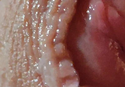 Dilation of the Glans Eye Has a Pleasant Surprise.