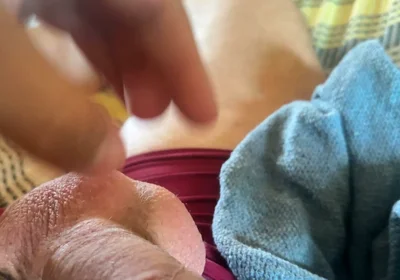 Extreme Venous Phimosis in the Pump!