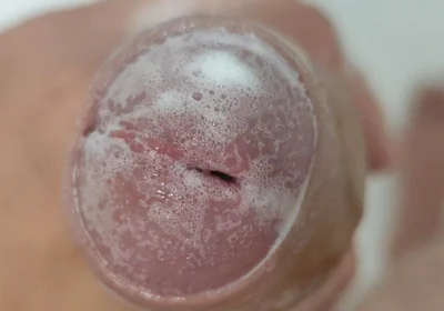 Extreme Burning Sensation Makes the Glans Foam with Arousal.