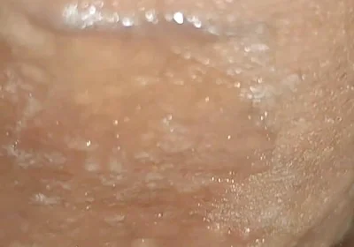 Scrotal Phimosis Results in an Extremely Hot Orgasm.