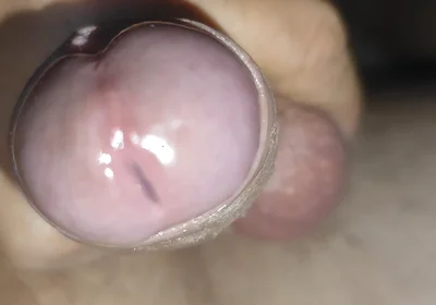 Scrotal Phimosis Results in an Extremely Hot Orgasm.