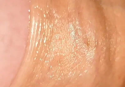 Difficult Fluid Control Due to Straight Phimosis.
