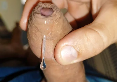 Difficult Fluid Control Due to Straight Phimosis