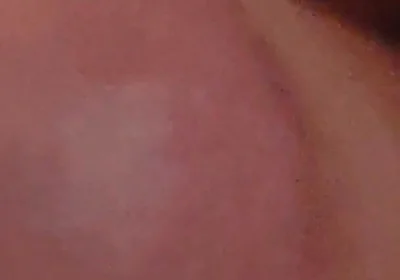 Immense Phimosis Being Extracted Cum and Précum.